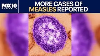 100+ measles cases confirmed in 9 states, per CDC | FOX 10 Phoenix