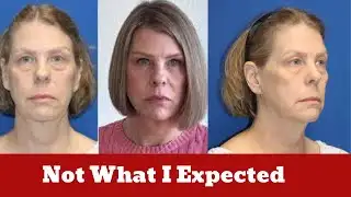 55-Year-Old Says Weight Loss Aged Her Face — Her ‘Undetectable’ Facelift Stunned Everyone