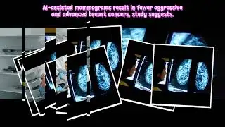 AI-assisted mammograms result in fewer aggressive and advanced breast cancers, study suggests#HLONG