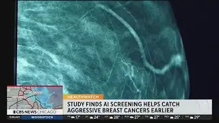 AI mammogram screening can help catch aggressive breast cancer earlier
