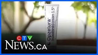 Albertans struggling with eczema see hope in new cream