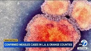 Another measles case reported in LA County