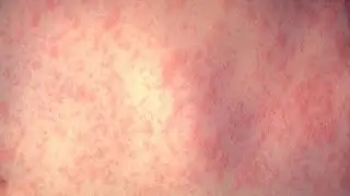 Authorities issue health warning after Brisbane measles case