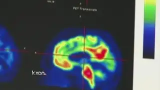 Biogen shares soar on optimistic Alzheimer’s drug study data