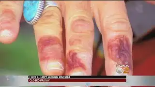 Bitter Cold Snap Raising Frostbite Concerns