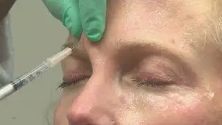 Botox results alter while on GLP-1 weight-loss drugs, study says