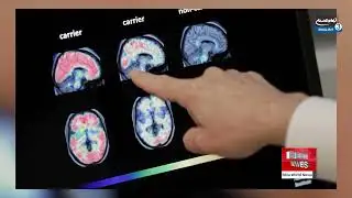 Brain Changes Linked to Depression Risk Persist After Recovery, Study Finds