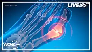 Breakthrough AI technology improves bunion surgery: How it works