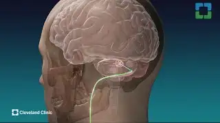 Cleveland Clinic: Deep brain stimulation study for stroke paralysis