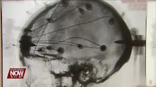 Cleveland Clinic study explores deep brain stimulation for stroke patients