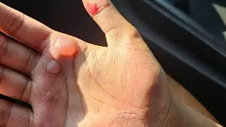 Coach resigns after 2 Warren Central students suffer second-degree burns after dance practice