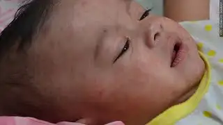 Covering Your Health: Measles outbreak not slowing down