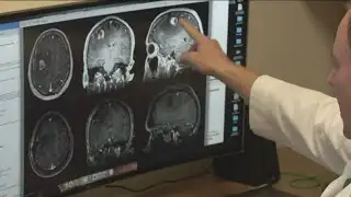 COVID-19 pandemic accelerated brain age, study shows