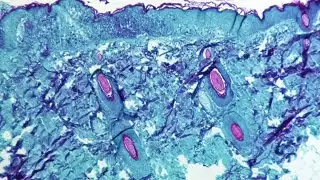 Denton County officials identify two more presumptive monkeypox cases