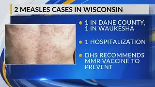 DHS confirms another measles case in Wisconsin, student at UW-Madison