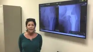 Direct Anterior total hip replacement - 8 days after surgery