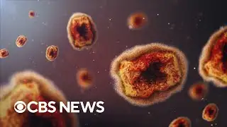 Dispelling the myths about monkeypox