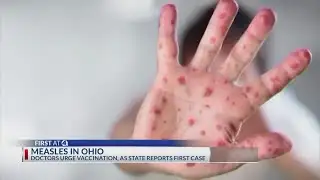 Doctors urge vaccinations as Ohio reports first measles case