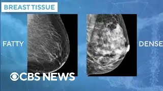 Doctors using AI mammogram readings to predict breast cancer risk
