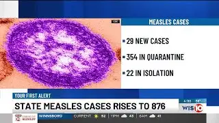 DPH confirms case of measles in Sumter County, more possible exposure