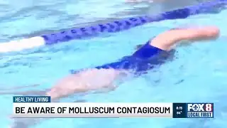 Dr. Griggs: Be aware of molluscum contagiosum