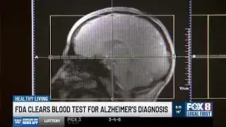 Dr. Griggs: FDA Clears Alzheimer’s Disease Test