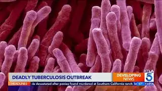 Dr. Suman Radhakrishna Talks Tuberculosis Outbreak on KTLA