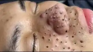 Extreme Blackhead Removal on Nose – Satisfying Deep Cleansing