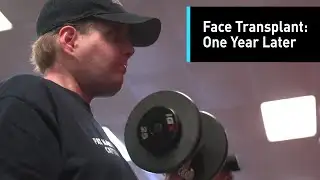 Face transplant: one year later