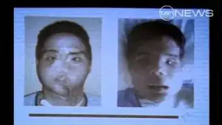 Face Transplant Success