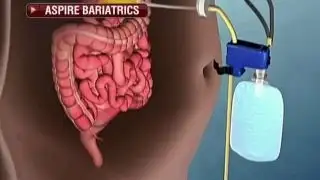 FDA approves weight-loss pump