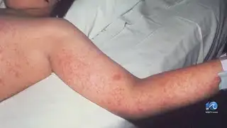 First confirmed case of measles reported in Virginia: VDH