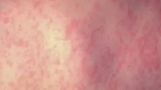 First measles case confirmed in Maricopa County