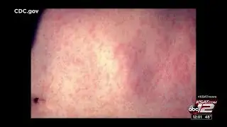 First measles case confirmed in San Antonio