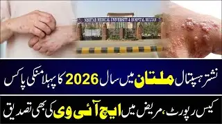 First Monkey Pox case of 2026 reported at Nishtar Hospital Multan