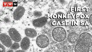 First monkeypox case confirmed in SA