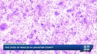 Five measles cases confirmed in Lancaster County