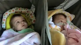 Formerly conjoined twins defy odds again