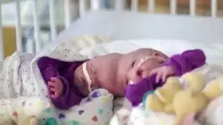 Formerly conjoined twins undergo risky 11-hour surgery to be separated.