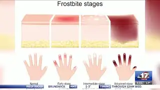 Frostbite risk high in Missouri as temperatures drop and wind chills rise, doctors say