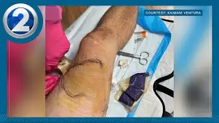 Hawaii man survives shark bite, recounts the ‘chomp’