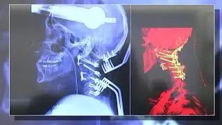 Health Watch: Robotic Spinal Surgery