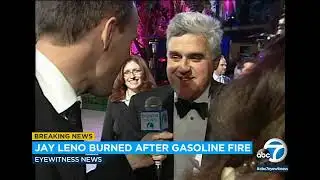 Jay Leno suffers serious burns from gasoline fire, reports say