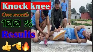 Knock knee problem one month result || Easy exercise to remove knock knee || knock knee ||