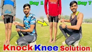 Knock knee problem solution | Knock knees best exercise and tips in Hindi