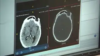 Lack of sleep may increase dementia risks, study finds