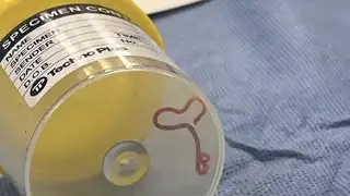 Live worm removed from woman’s brain in world-first discovery