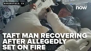 Man allegedly set on fire in Taft faces long recovery