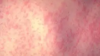 Measles case confirmed in Georgia
