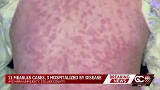 Measles cases linked to Ave Maria University rise to 11; 4 hospitalized